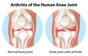Illustration,Of,An,Arthritis,Of,The,Human,Knee,Joint,On knee-arthritis-treatment