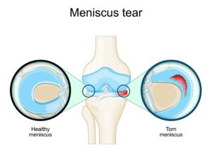Meniscus tear and normal meniscus image